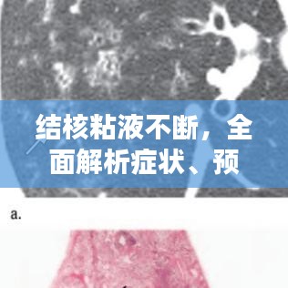 結核粘液不斷，全面解析癥狀、預防與治療措施