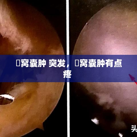 腘窩囊腫 突發(fā)，腘窩囊腫有點(diǎn)疼 